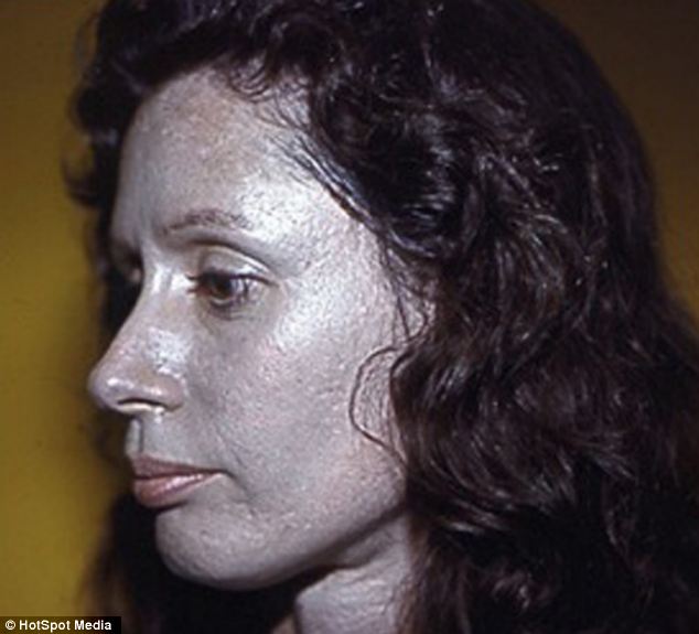 Essa mulher foi tratada por vários anos com um remédio que continha prata em sua composição e sua pele ficou assim, azulada! (foto: Reprodução) 