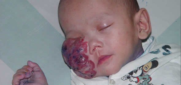 Foto de um bebê com tumor no rosto circula pelo Facebook!