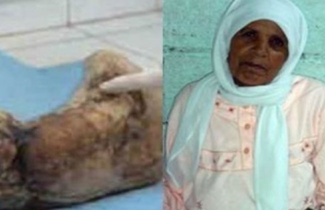 Zahra Aboitalib ao lado do feto extraído de sua barriga! (foto: reprodução/YouTube)