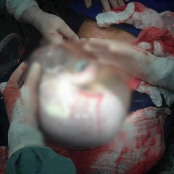 Médicos teriam tirado um bebê com placenta para que ele não fosse infectado pela mãe! Será verdade? (foto: Reprodução Facebook)