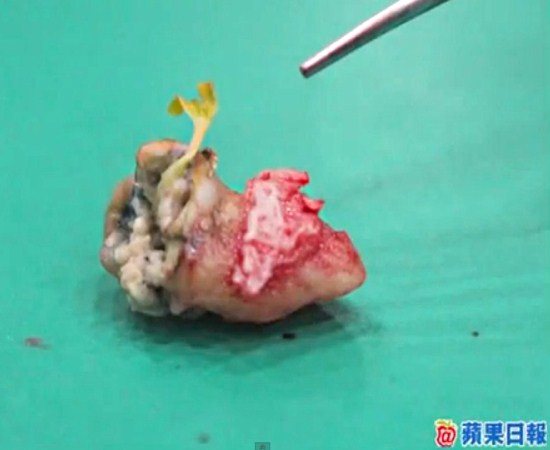 Semente de goiaba germina no dente de paciente na China!