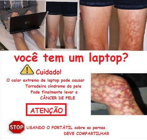 O calor do laptop causa queimaduras e câncer de pele?