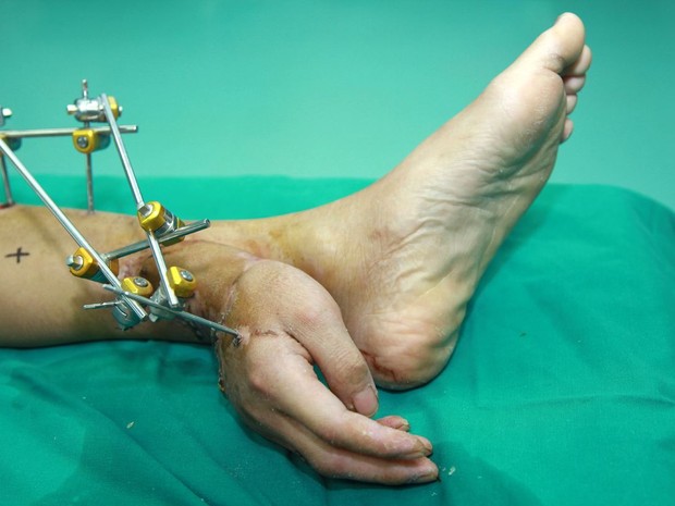 Médicos teriam implantado a mão de um paciente em seu pé! Verdadeiro ou falso? (foto: reprodução)