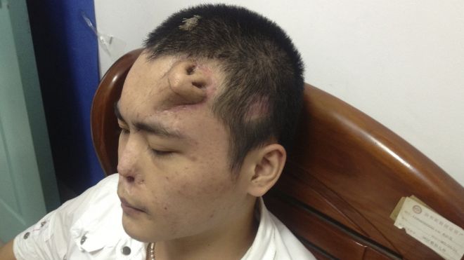 Rapaz tem um nariz implantado em sua testa. Verdadeiro ou falso? (foto: Reprodução/Reuters)