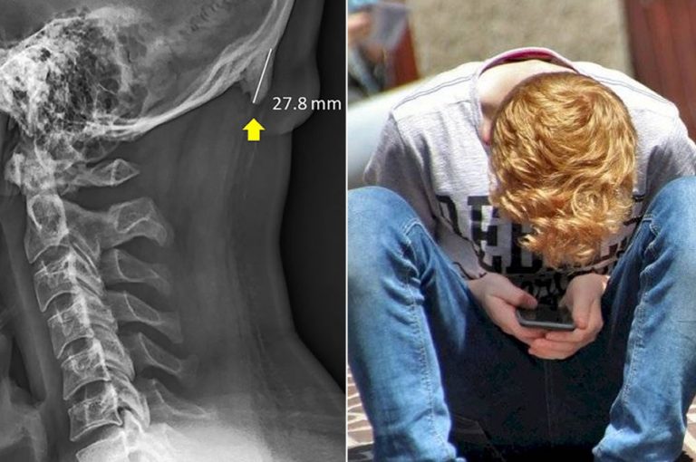 Cientistas descobriram “chifres” em crânios de jovens devido ao mau uso do celular?