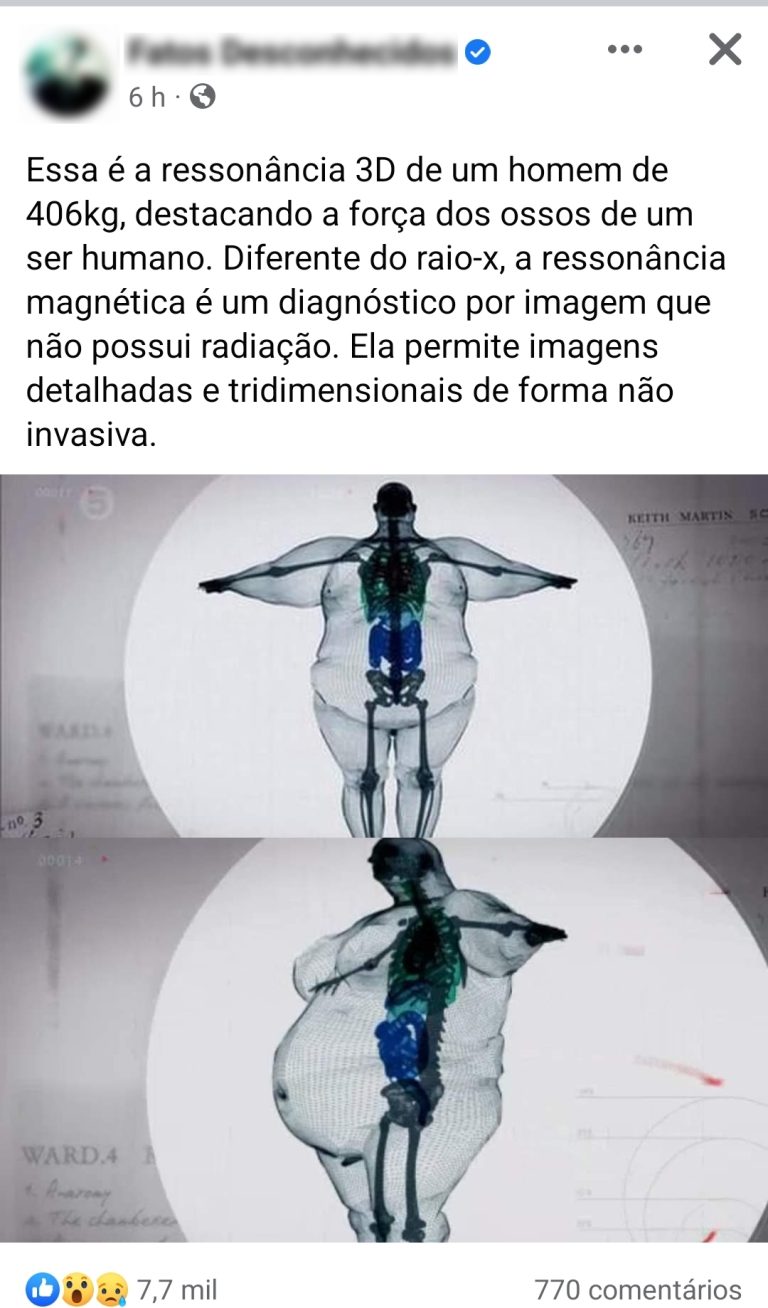 Imagens mostram a ressonância magnética de um homem de 406 kg! Será verdade?