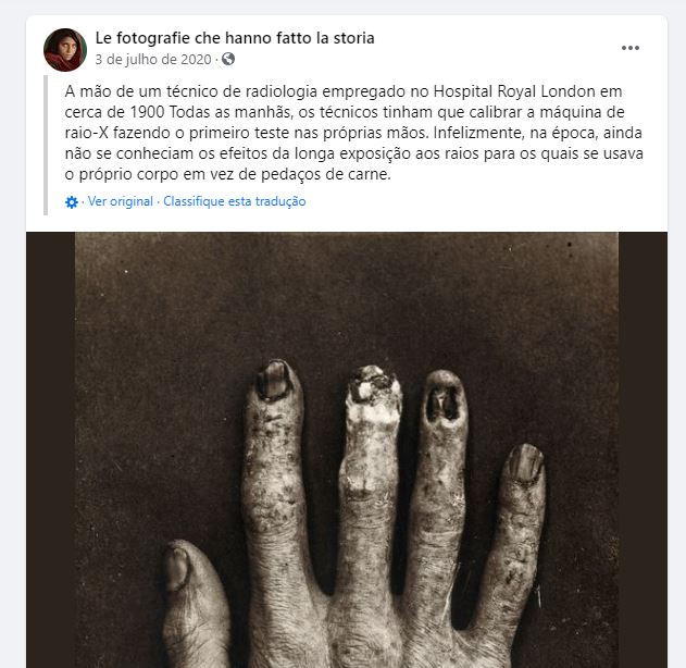 Foto mostra uma mão de um radiologista destruída por raios X! Será verdade?